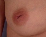 Nipple - Inversion Correction