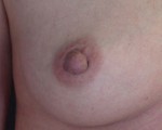 Nipple - Inversion Correction