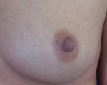 Nipple - Inversion Correction