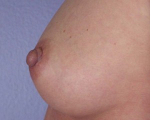 Nipple - Inversion Correction