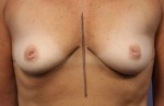 Nipple - Inversion Correction