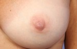 Nipple - Inversion Correction