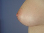 Nipple - Inversion Correction