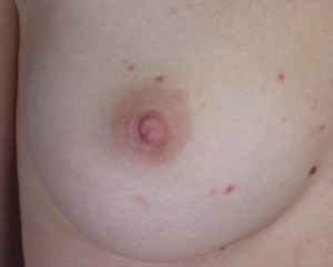 Nipple - Inversion Correction