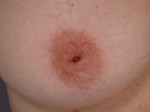 Nipple - Inversion Correction