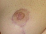 Nipple - Inversion Correction