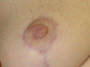 Nipple - Inversion Correction