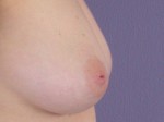 Nipple - Inversion Correction