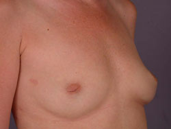 Nipple - Inversion Correction