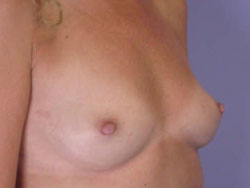 Nipple - Inversion Correction