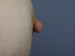 Nipple – Areola Correction