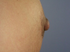 Nipple – Areola Correction