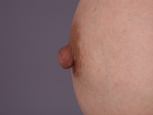 Nipple – Areola Correction