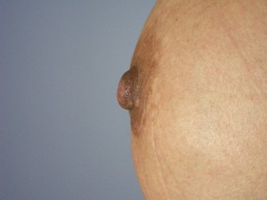 Nipple – Areola Correction