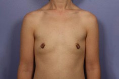 Nipple – Areola Correction