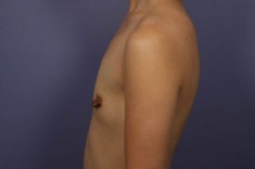 Nipple – Areola Correction