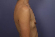 Nipple – Areola Correction