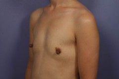 Nipple – Areola Correction