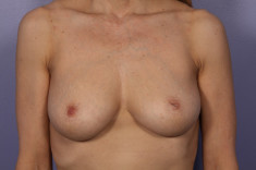 Nipple - Inversion Correction