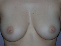 inverted nipple repair Los Angeles