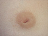 Los Angeles Inverted Nipple Repair