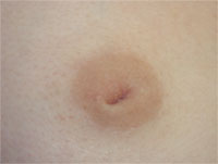 Los Angeles Inverted Nipple Repair