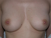Southern California Inverted Nipple Repair