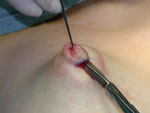 Los Angeles Inverted Nipple Repair